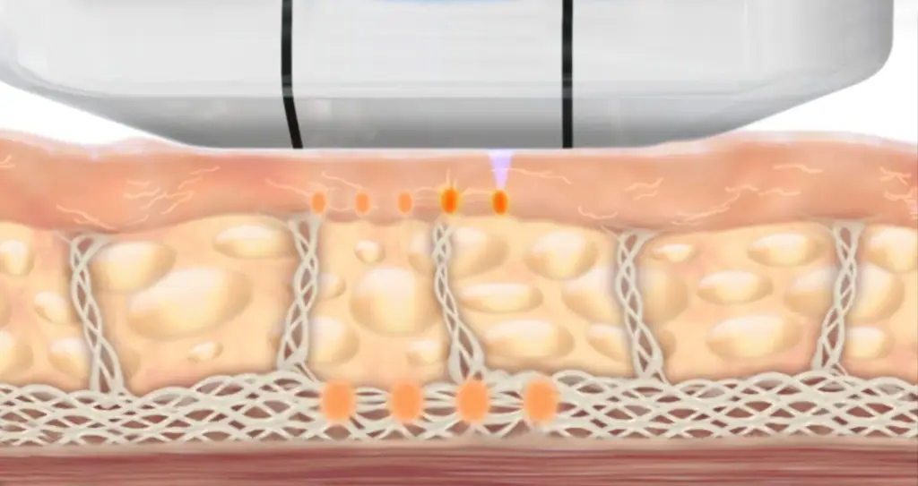 ULTHERA – EINE MODERNE METHODE DER HAUTSTRAFFUNG DURCH ULTRASCHALL