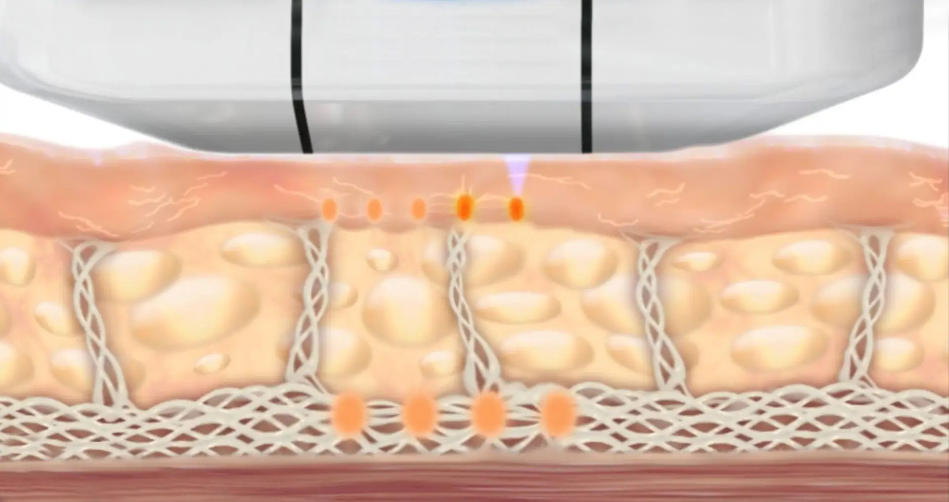 ULTHERA – EINE MODERNE METHODE DER HAUTSTRAFFUNG DURCH ULTRASCHALL